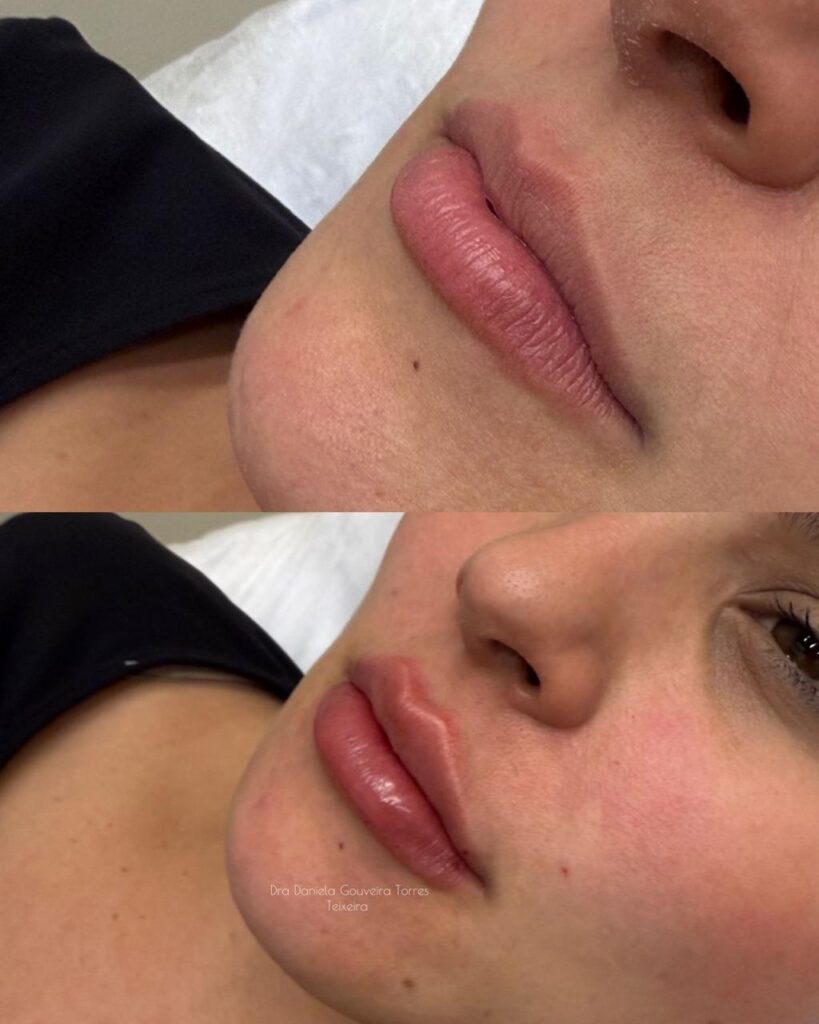 Preenchimento Labial