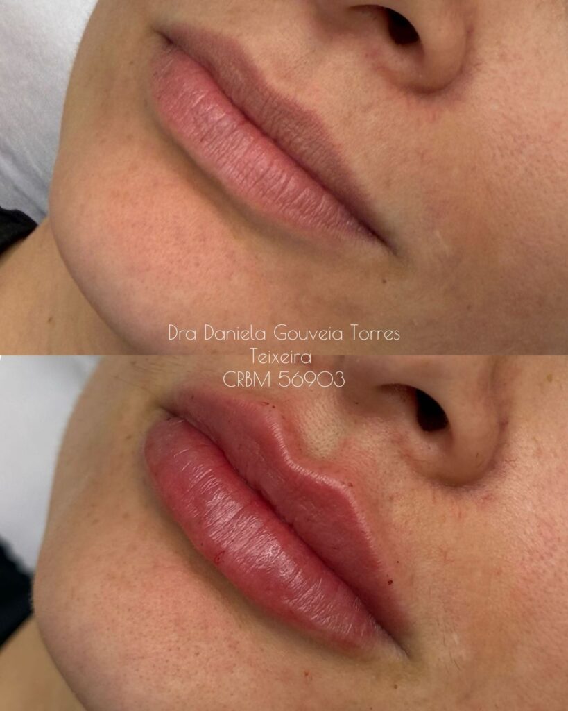 Preenchimento Labial
