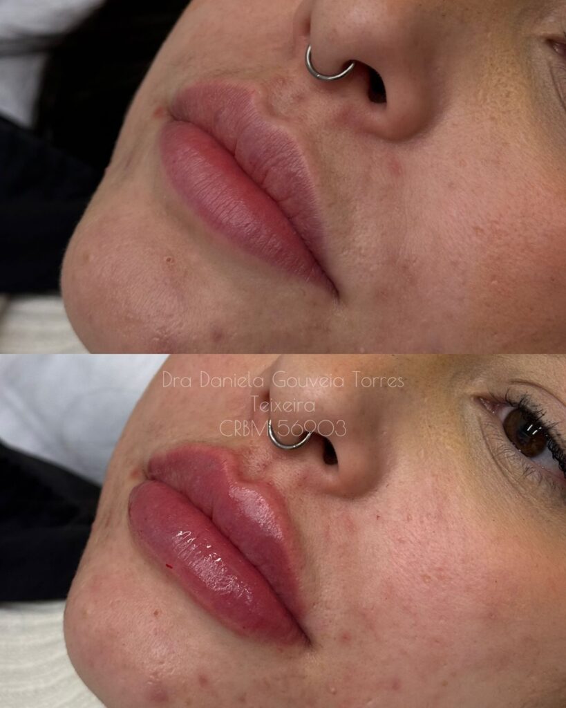 Preenchimento Labial