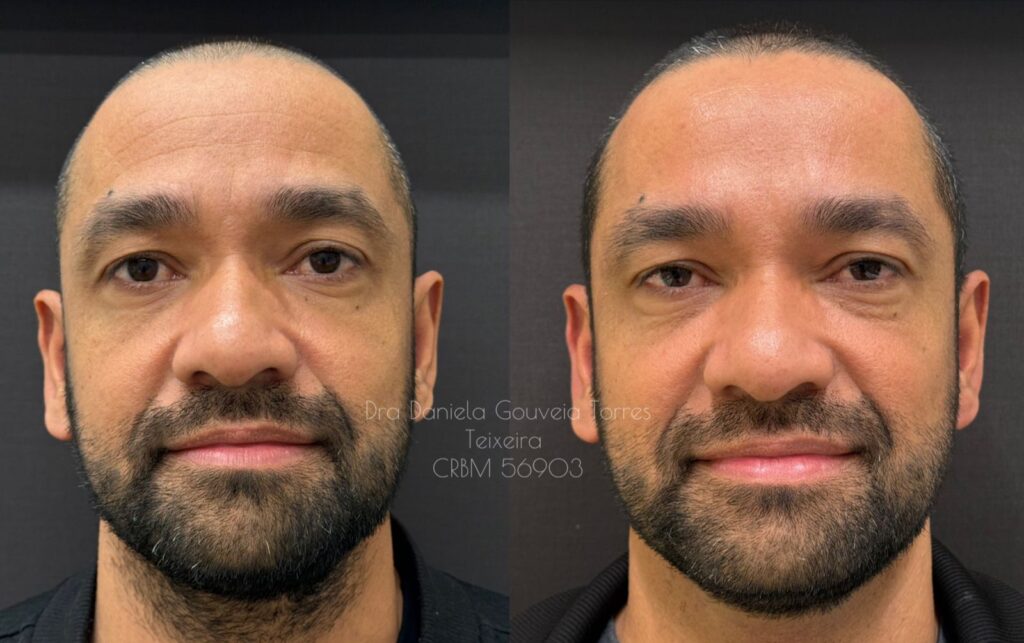 Toxina botulínica masculina