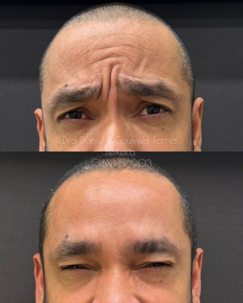 Toxina botulínica masculina